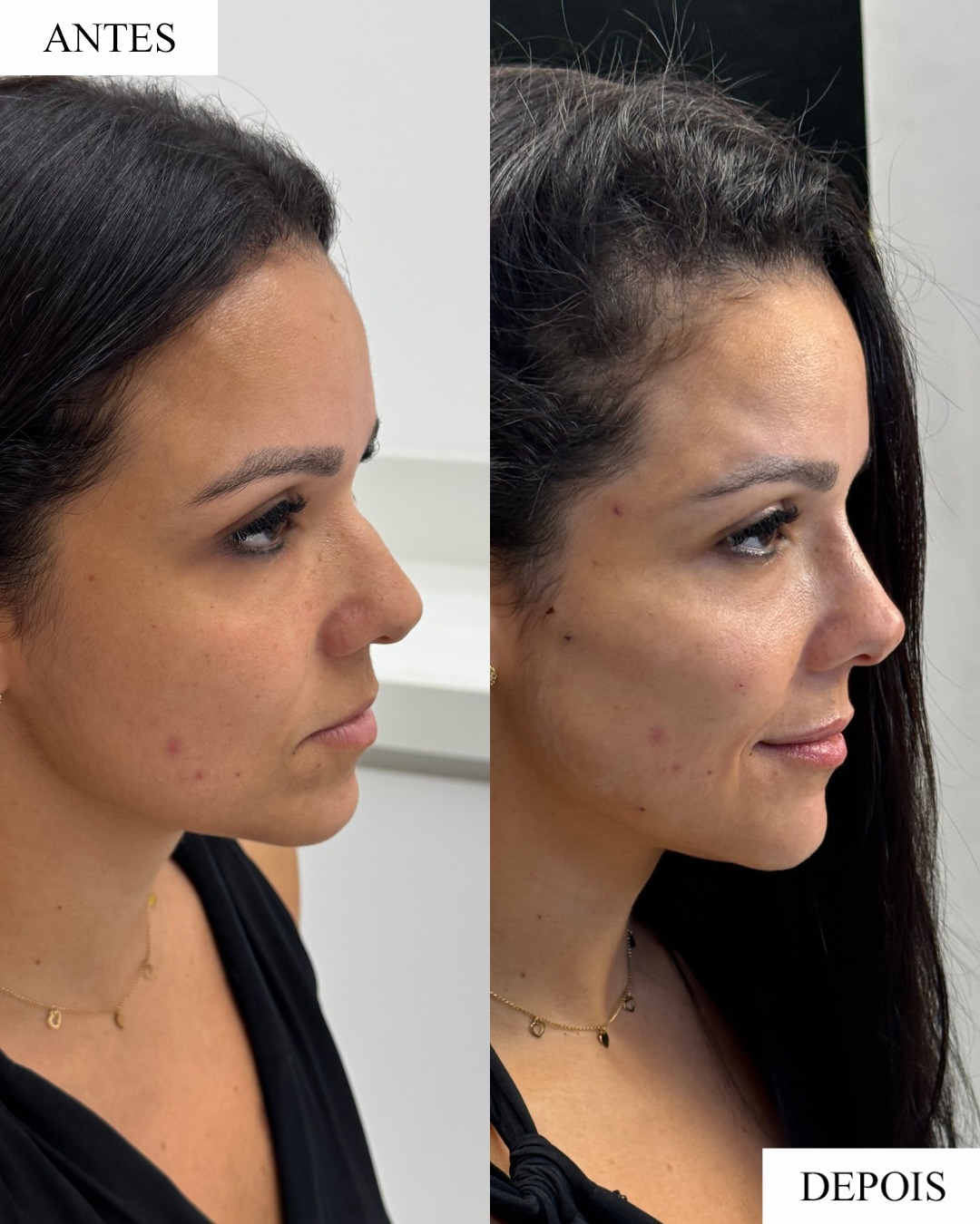 Antes e depois de rinomodelação realizada pela Dra. Jeane Barbosa